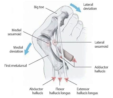 41 best images about Not Good Looking...Bunions on Pinterest | Foot anatomy, Hammer toe and ...