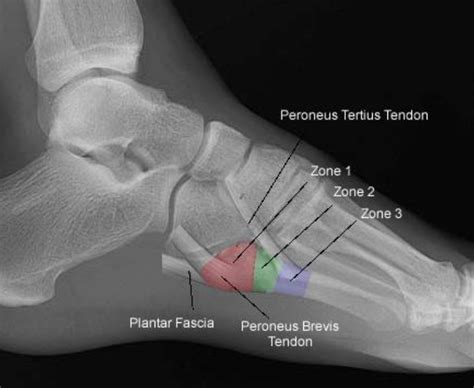 Jones Fractures – Core EM | Jones fracture, Emergency medicine, Fractures