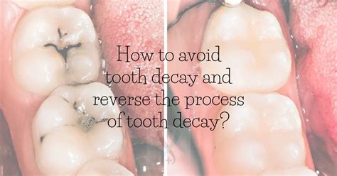 How to avoid tooth decay and reverse the process of tooth decay? - Expert Dental Care