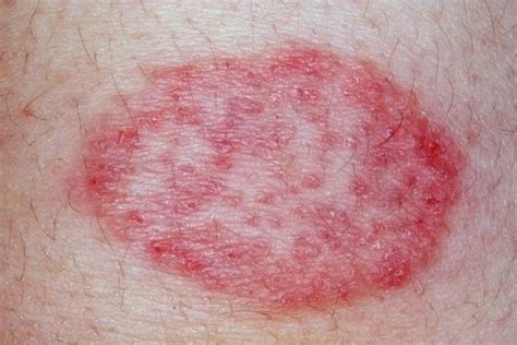 6 Common Causes For Itchy Butt Rashes And Bumps