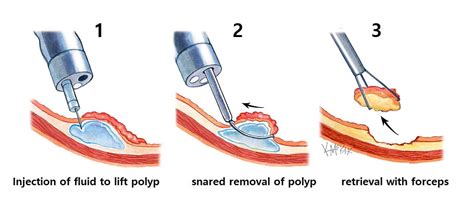 7 Photos Carpet Polyp And Review - Alqu Blog