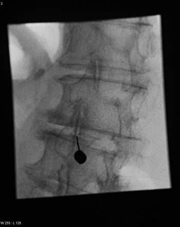 Facet joint injection | Radiology Reference Article | Radiopaedia.org