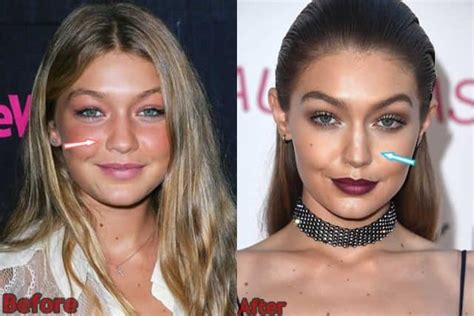 Gigi Hadid Plastic Surgery Before And After Photos