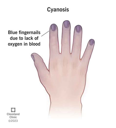 Cyanosis (Blue Hands & Feet): Causes, Treatment & Diagnosis