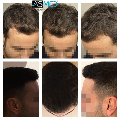 Norwood 3 Hair Transplantation Results | Asmed Hair Transplant