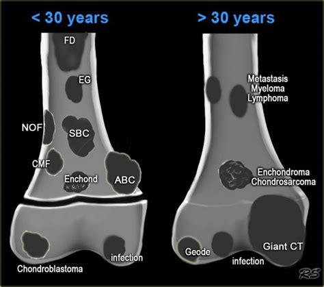 The Radiology Assistant : Osteolytic - well defined bone tumors