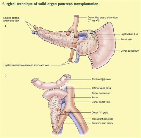 Pancreas transplantation - Surgery - Oxford International Edition