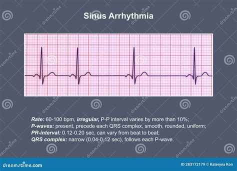 Electrocardiogram ECG Displaying Sinus Arrhythmia, 3D Illustration | CartoonDealer.com #283172179