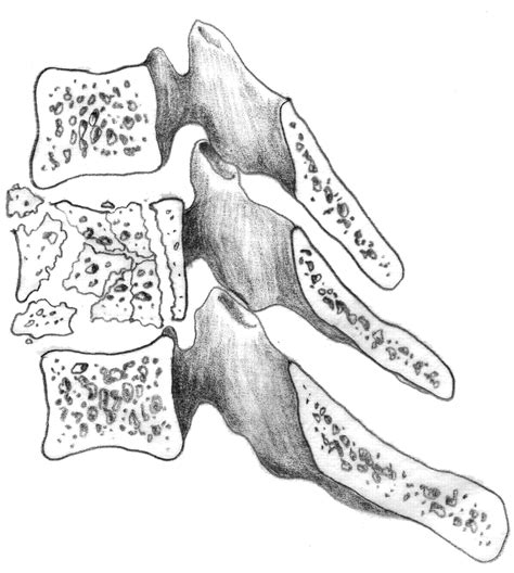 What is a Spinal Burst Fracture? | Minnesota Workers' Compensation Blog ...