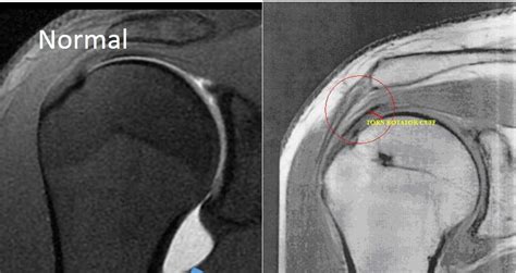 Rotator Cuff MRI Images