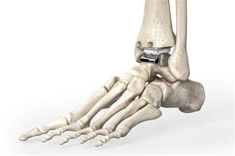 Ankle Replacement Recovery | Centeno-Schultz Clinic