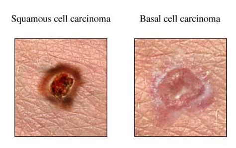 Squamous Cell Cancer – Park Avenue Dermatology | Dermatologist in Orange Park, Jacksonville, FL