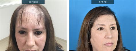 Hair Transplant for Women | Female Baldness Treatment