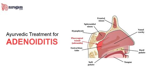 Ayurvedic Treatment for Adenoiditis – Nirogam