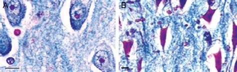 Hippocampal pyramidal cells stained for Al from human brains of an ...