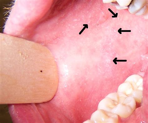 Koplik spots in early measles | CMAJ