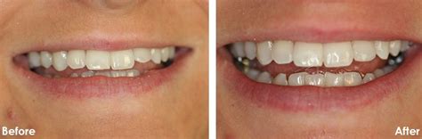 Dental Bonding Before And After - Dental News Network