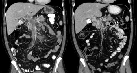 Portal vein thrombosis overview - wikidoc