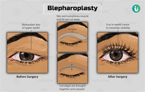 Blepharoplasty: Procedure, Purpose, Results, Cost, Price