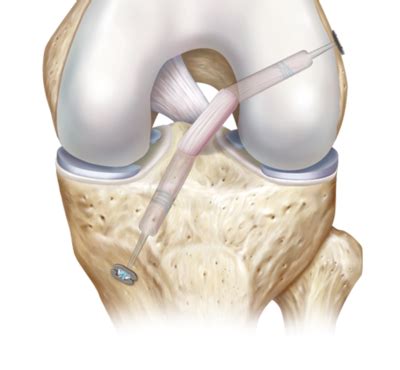 Arthrex - ACL Reconstruction