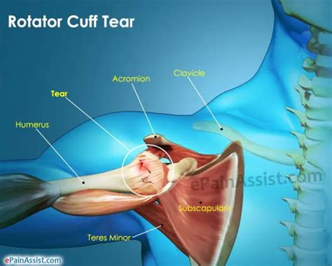 How To Rehab Rotator Cuff Minor Tear