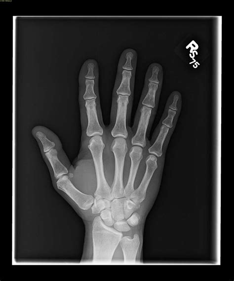 Triquetral fracture - X Rays Case Studies - CTisus CT Scanning