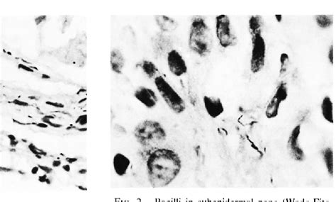 Figure 2 from Histology of indeterminate leprosy. | Semantic Scholar