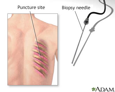 Lung needle biopsy Information | Mount Sinai - New York