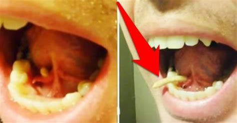 Man Squeezes Out GIANT Salivary Gland Stone From Under His Tongue ...