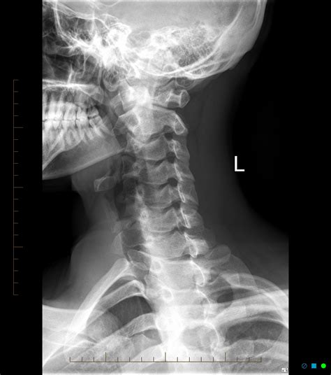 Upper Cervical Spine Anatomy