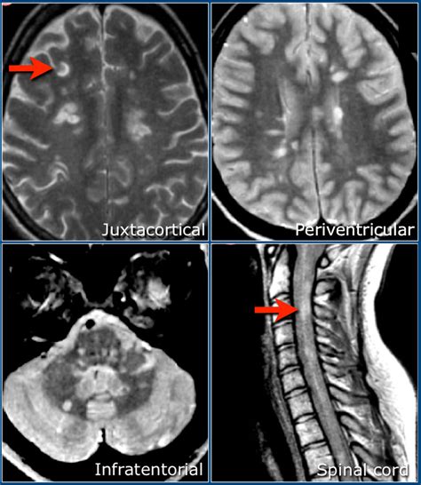 The Radiology Assistant : Multiple Sclerosis