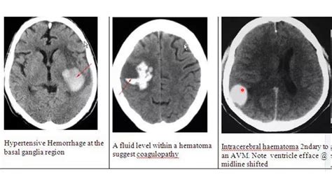 Basics of brain CT scan part III - YouTube