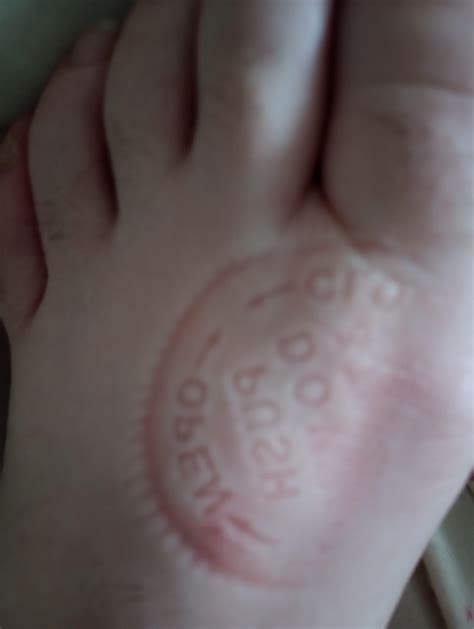 a skin imprint of a lid on my foot it was from a bottle of sleeping pills : r/mildlyinteresting