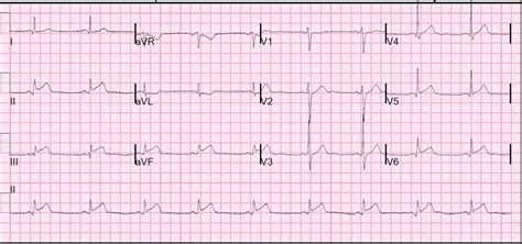 Dr. Smith's ECG Blog: Inferior STEMI: can we predict the infarct related artery?