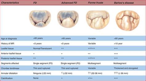 Barlow Disease Mitral Valve - Captions Trending Update