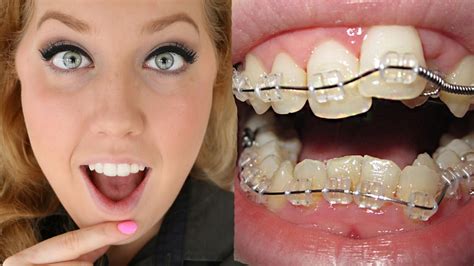 Clear Bracket Braces Before And After