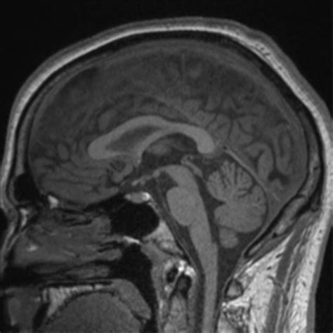 Normal MRI pineal gland | Image | Radiopaedia.org