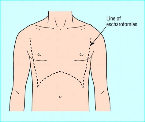 File:Escharotomy.jpg - Protocopedia