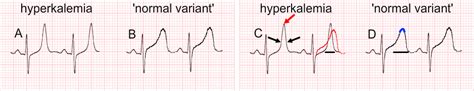 High s waves ecg causes - kumbangkok