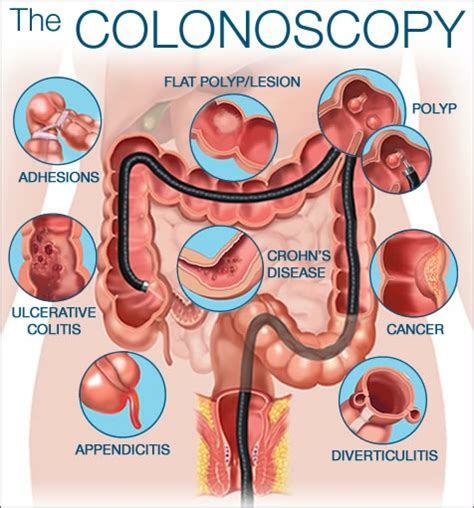 Colonoscopy for bowel problems | Glasgow Colorectal Centre