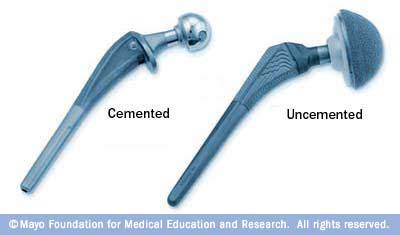 Two types of hip implants - Mayo Clinic