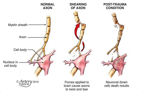 Diffuse Axonal Injury - Google Search | Tramatic brain injury, Brain injury, Traumatic brain injury