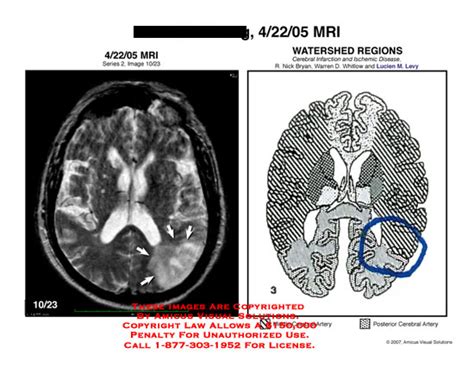 Brain MRI