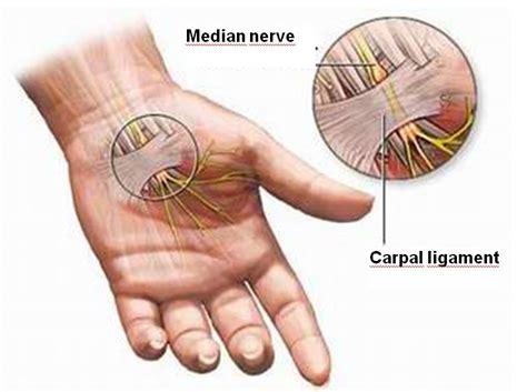 Carpal Tunnel Syndrome Causes | Homeopathic Treatment