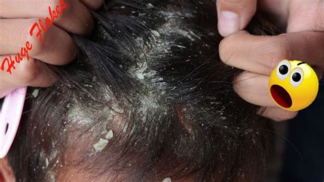 Scalp scratching and picking Satisfying Dandruff Removal Psoriasis on my girl Friend - YouTube