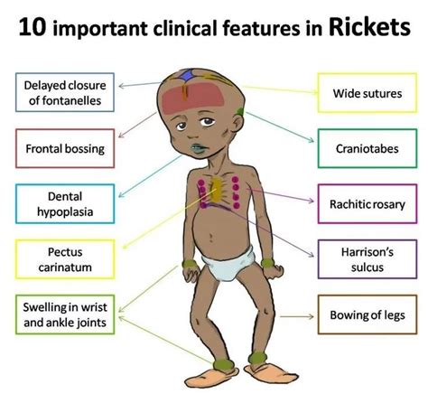 Rickets Symptoms, Diagnosis, Treatment - Rxharun