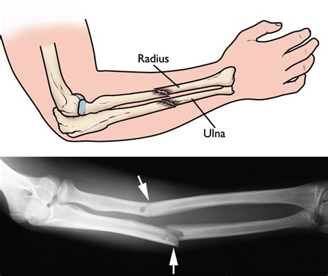 RADIUS FRACTURE — Miami Bone & Joint Institute | Premier Center For Upper And Lower Extremity