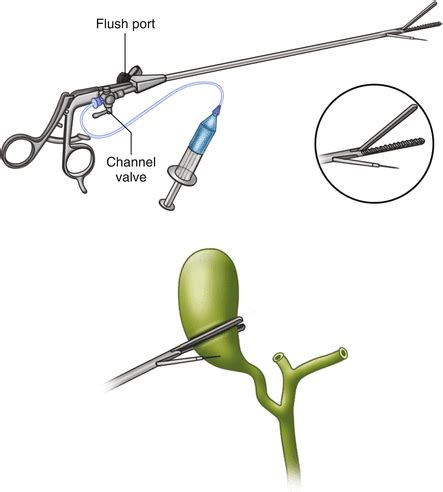 The Use of Routine and Selective Intraoperative Cholangiography | Anesthesia Key