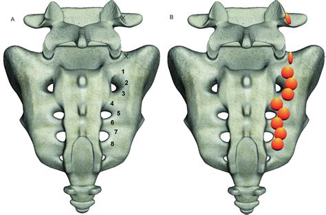 Sacroiliac Joint Nerve Block