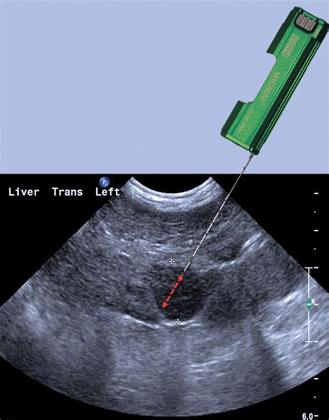 Ultrasound-Guided Biopsy of the Liver | Clinician's Brief